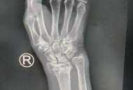 扳手腕致手臂骨折,扳手腕致手臂骨折算轻伤吗