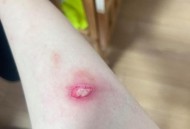 冬天低温烫伤高发季,夏天低温烫伤