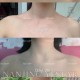 女子打瘦肩针险丧命,瘦肩针200和300区别？