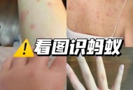 被蚂蚁咬伤身亡,被蚂蚁咬伤身亡怎么办