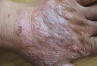 最疼皮肤病高发期,皮肤病的高发期