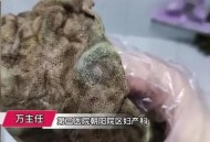 术后体内留纱布发臭,术后体内留纱布发臭怎么回事