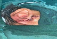 男子剪发耳朵被剪裂,男子理发时耳朵被剪掉一块肉算几级伤害？