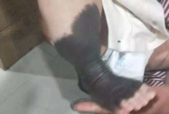 产检正常却长兽皮痣,兽皮痣去掉后的样子？