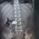 男童误吞遥控器电池,遥控器吃电是怎么回事？