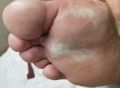 袜子塞鞋或诱发脚气,为什么穿地摊的袜子会臭脚气啊，是材料太糟糕了吗？