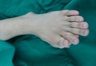 吸烟12年脚趾险截肢,男子抽烟20年3个脚趾坏死截肢