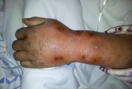 被蜂蛰拔几十根毒刺,被蜂蛰拔几十根毒刺会怎么样