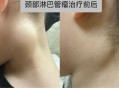 脖子长瘤跟头一样大,脖子上长一个瘤跟癌有什么区别