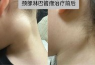 脖子长瘤跟头一样大,脖子上长一个瘤跟癌有什么区别