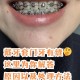 戴牙套5年坏了8颗牙,牙齿已经带了牙套，牙齿又开裂了，会怎么样？