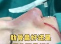 3万隆鼻熟人拿走2万,用别人的肋软骨隆鼻有哪些危害? 3万隆鼻熟人拿走2万,用别人的肋软骨隆鼻有哪些危害?