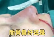 3万隆鼻熟人拿走2万,用别人的肋软骨隆鼻有哪些危害？