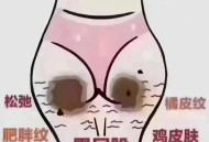 久坐屁股会变黑,久坐屁股会变黑吗