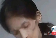 27岁女孩胃萎缩去世,胃萎缩怎么治疗？