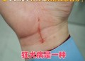 咬破手指写字求救,求助：一年内被猫咬两次，第二次还用打狂犬疫？