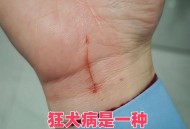 咬破手指写字求救,求助：一年内被猫咬两次，第二次还用打狂犬疫？