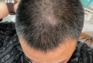 34岁妈妈满头白发,34岁，最近两年白发有增多的现象，多在头顶和两鬓，洗头头发也掉的厉害，怎么办？