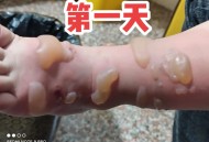 男童被沸水烫伤下肢,衣服用开水烫会怎么样？