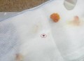 遭飞来石头砸脸毁容,石头烂了怎么办？