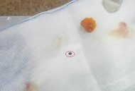 遭飞来石头砸脸毁容,石头烂了怎么办？