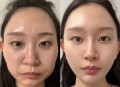 暑期青少年扎堆整容,暑期青少年扎堆整容案例
