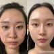 暑期青少年扎堆整容,暑期青少年扎堆整容案例