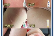 冬天洗澡可能得湿疹,宝宝天天洗澡会不会得湿疹？