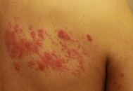 曝知名歌手患蛇缠腰,俗称“蛇缠腰”是什么病。发病时有什么症状？
