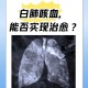 发热1天左肺全白,左肺发白,晚上发烧白天正常