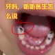 4岁娃全麻拔乳牙身亡,小朋友补牙可以走医保吗？