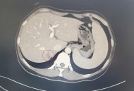 患癌肝被肿瘤占近半,当癌症转移时，它通常会先转移到肝脏，为何癌细胞容易转移到肝脏？