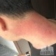 做艾灸致2度烫伤,艾灸严重烫伤