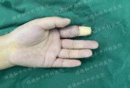 被断4根手指已恢复,被断4根手指已恢复怎么办
