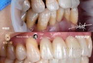 牙周炎一次拔14颗牙,牙周炎一次拔14颗牙可以吗