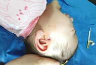 亲10月龄娃脚后嘴肿,小孩脚肿嘴肿是什么情况