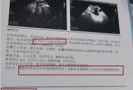 患癌肝被肿瘤占近半,肝癌占肿瘤致死原因第几位