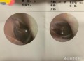 被邻居扇脸鼓膜穿孔,老师把学生打成鼓膜穿孔就怎么办？