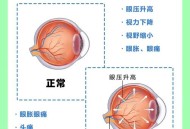 青光眼当感冒险失明,为什么感冒时颅内压和眼压会升高？
