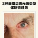 青光眼当感冒险失明,青光眼 感冒