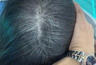 34岁妈妈满头白发,35岁年轻人长了几十根白头发，能通过饮食和休息让白发变黑吗？