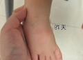 亲10月龄娃脚后嘴肿,宝宝脚肿了怎么回事？