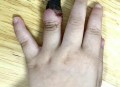 女童指尖被夹断,小孩手指被夹断图片