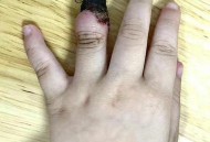 女童指尖被夹断,小孩手指被夹断图片