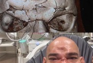 玩免费项目颅骨骨折,颅骨骨折要花多少钱