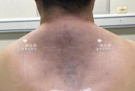 术后体内留纱布50天,腰间盘突出手术15厘米长伤口多少天就可以去掉纱布了？