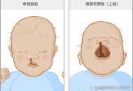 婴儿出生时脸部裂开,婴儿出生时脸部裂开怎么回事