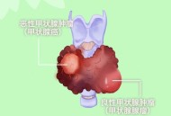 甲状腺癌越来越常见,甲状腺癌越来越常见,年轻人易中招