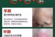 婚礼照被当垃圾扔掉,黑头党、草莓鼻、毛孔粗大，该怎么办？