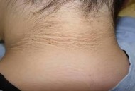 血糖失控的皮肤症状,血糖失控的皮肤症状有哪些